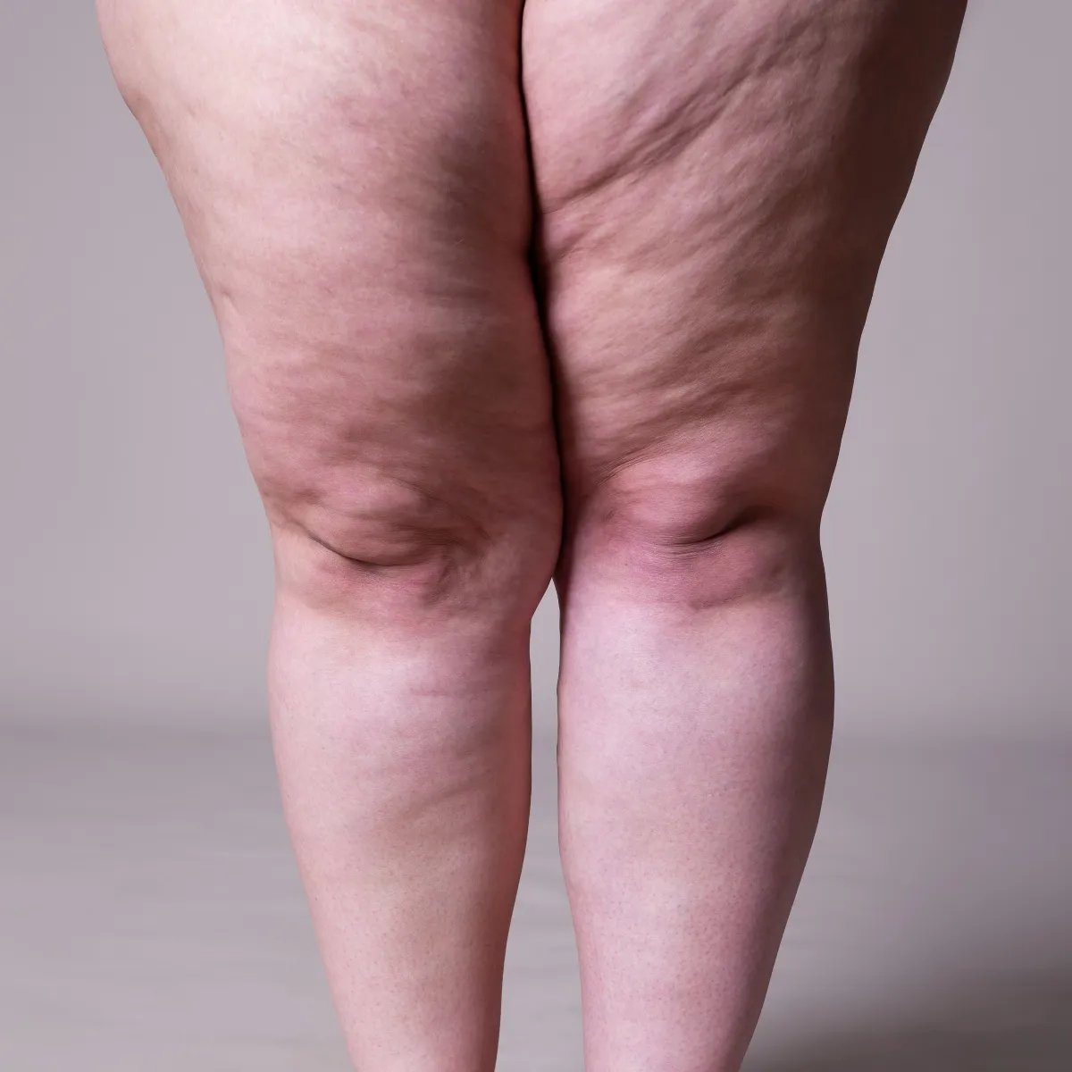 Detalhe das pernas de uma mulher, representando o lipedema